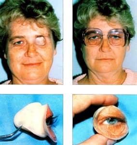 Maxilofacial Prosthesis