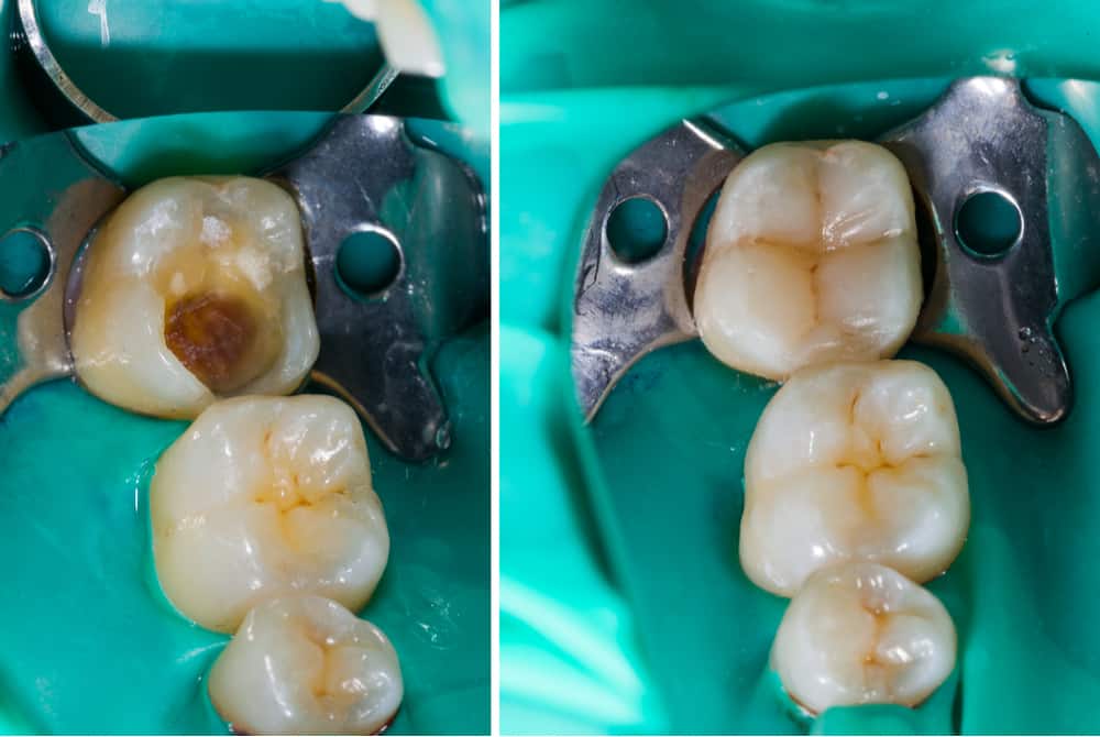 Cavity filling