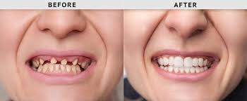 Permanent replacement